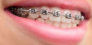  metal braces orthodontic treatment in Pune